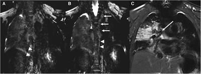 Case Report: Transcatheter interventional procedure to innominate vein turn-down procedure for failing fontan circulation